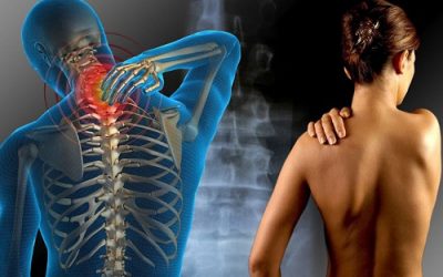 La fibromyalgie